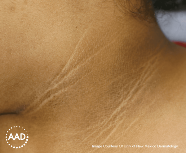 Acanthosis nigricans on Black skin