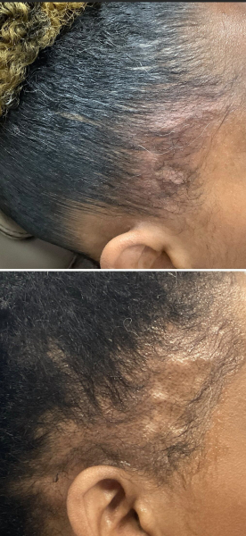 Traction alopecia on hair line